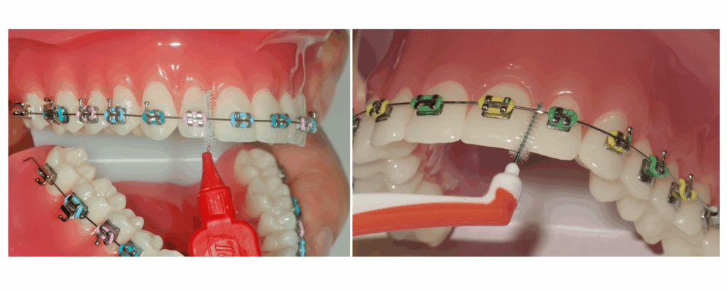 Inter dental brush for braces