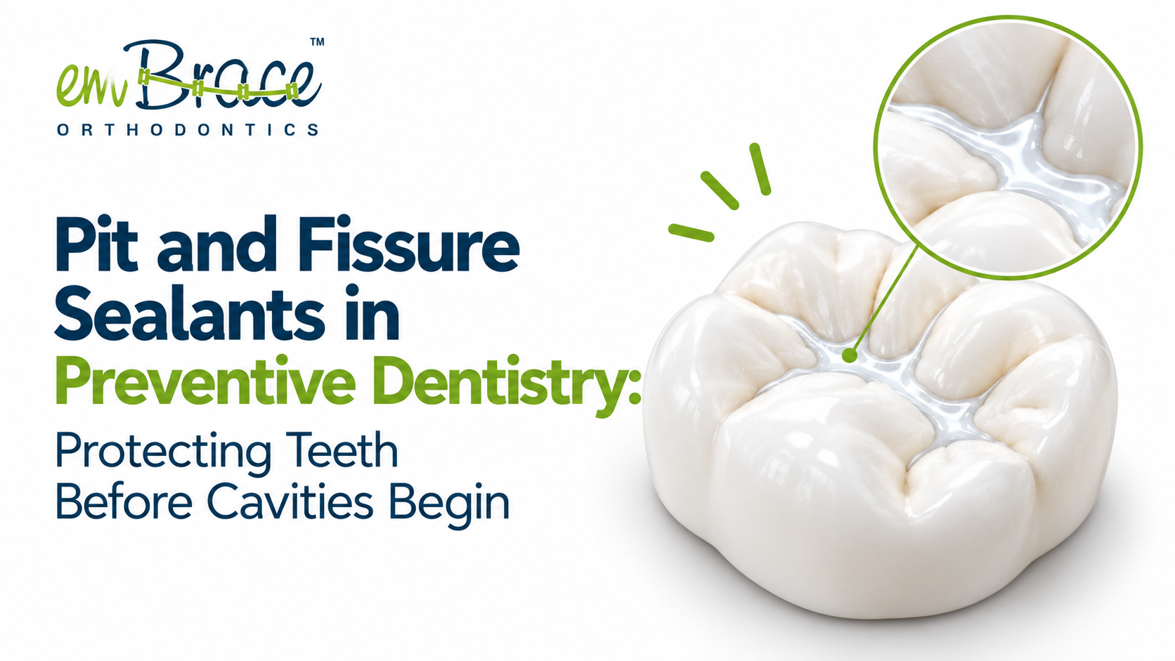 Pit and Fissure sealant in Preventive Dentistry