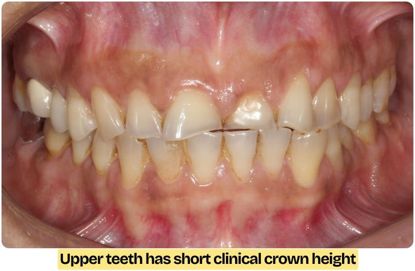 Teeth with short clinical crown height