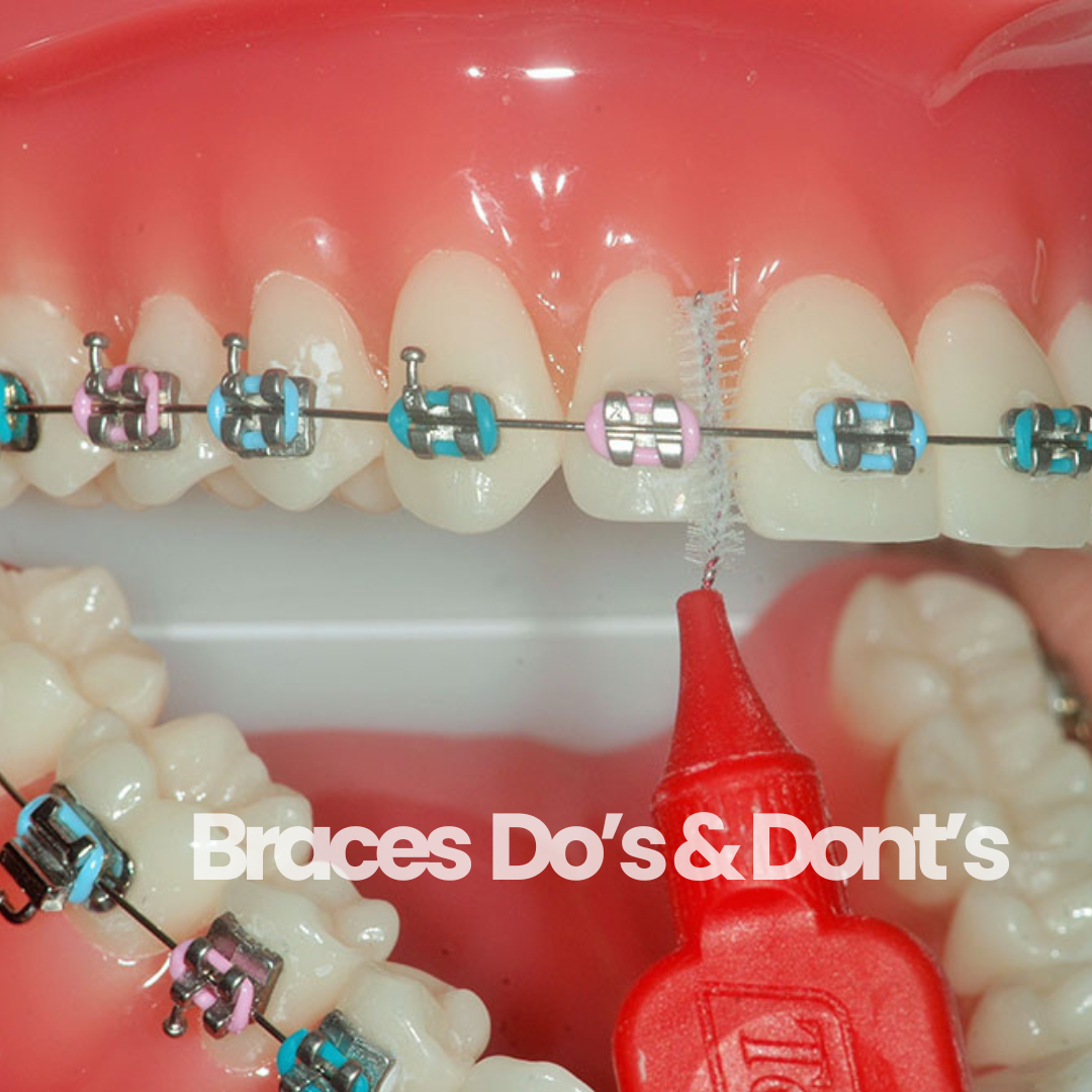 Invisalign Vs Braces, make an informed decision