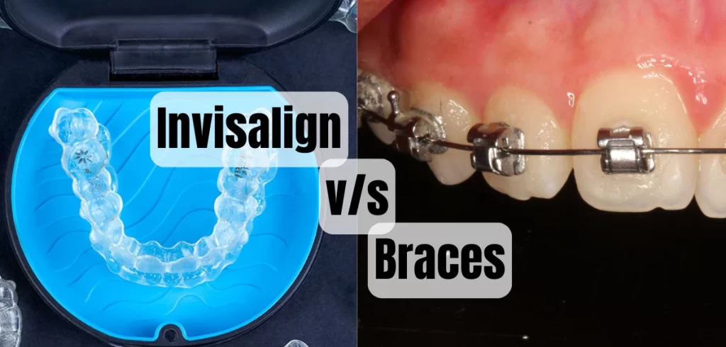 Invisalign vs Braces