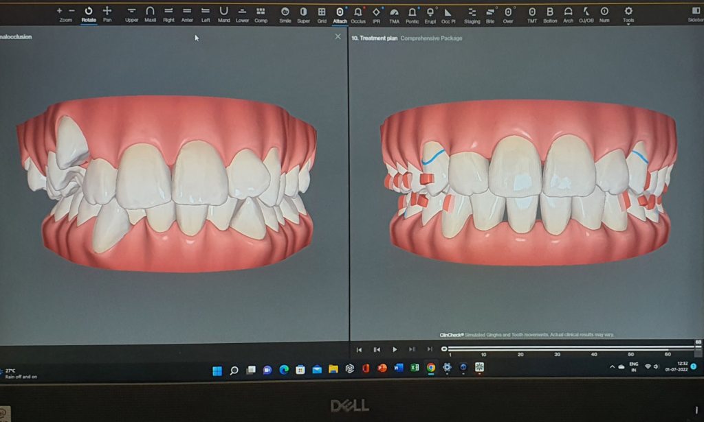 10 Hidden Reasons Your Invisalign Treatment Isn't Working