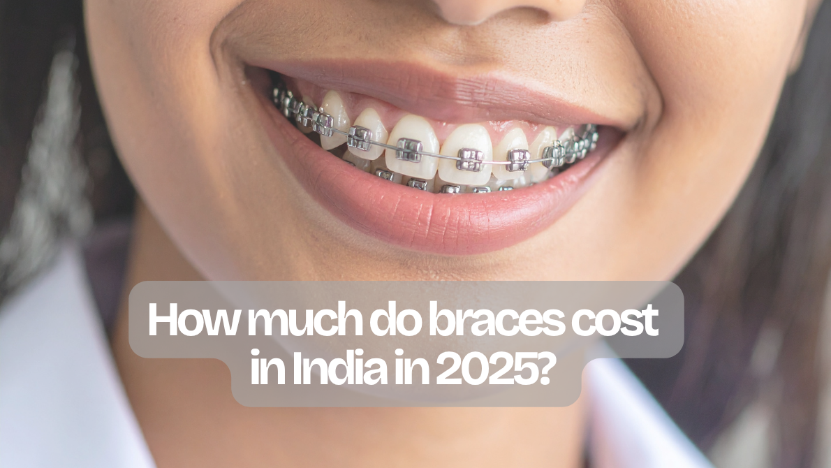 Braces cost in India