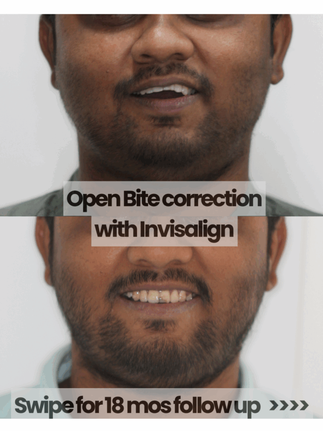 Open Bite correction with Invisalign & 18 months follow-up