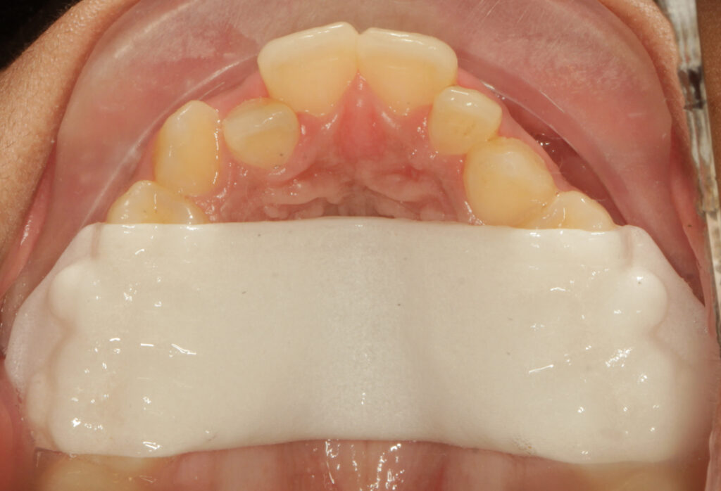 Invisalign Palatal Expander in India