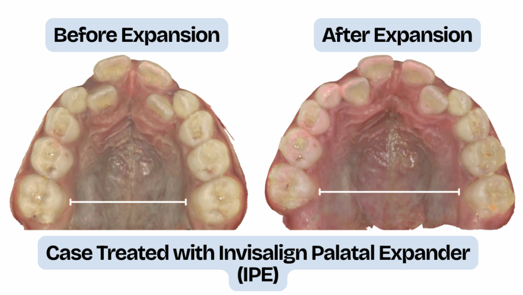 Invisalign Palatal Expander Before and After