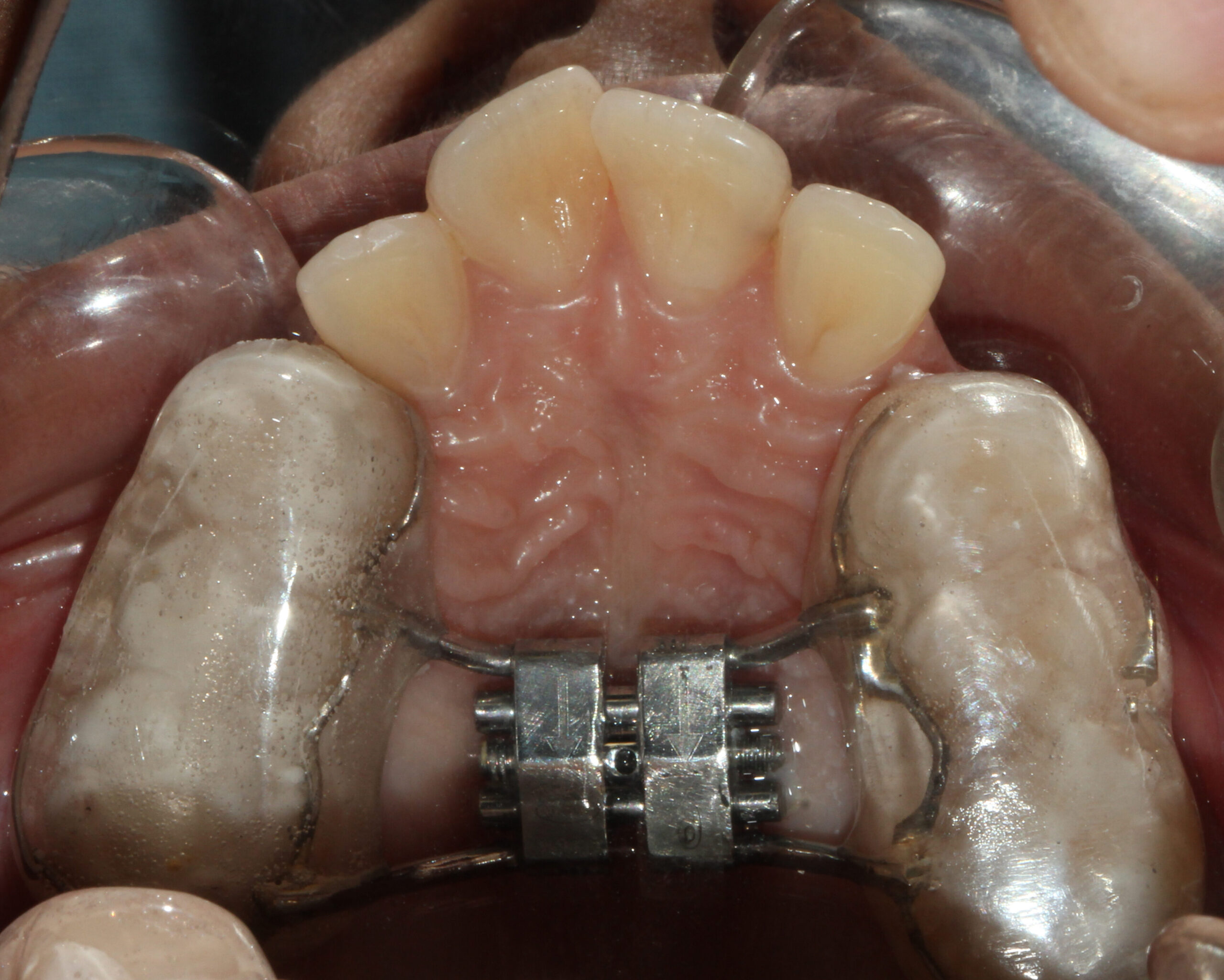 Traditional Palatal Expander