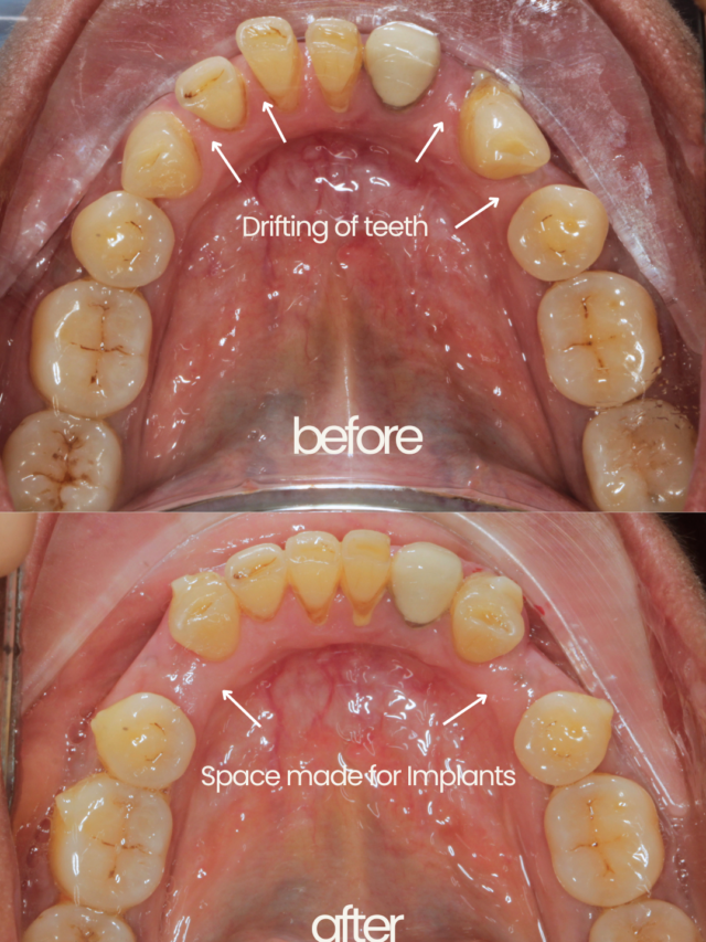 Invisalign for Complex cases