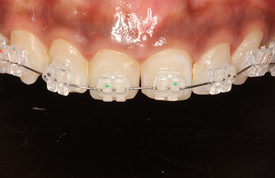 Self ligating ceramic on sale braces