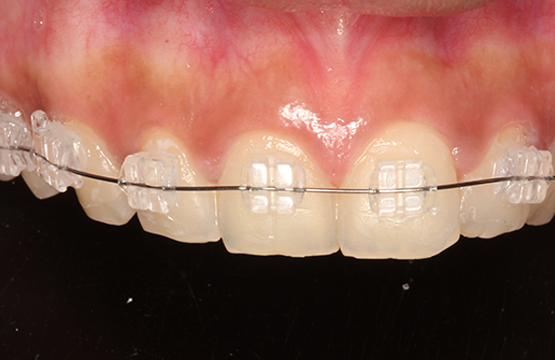 Ceramic Braces Treatment Cost in India